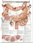 Understanding Colorectal Cancer Anatomical Chart